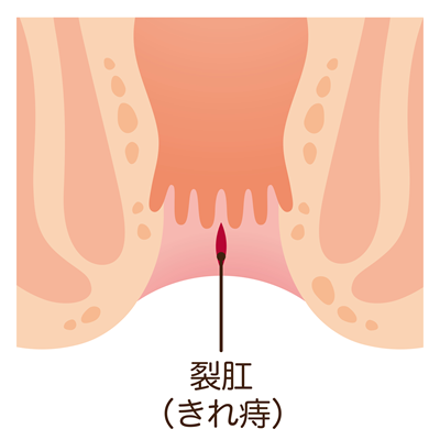 切れ痔(裂肛)