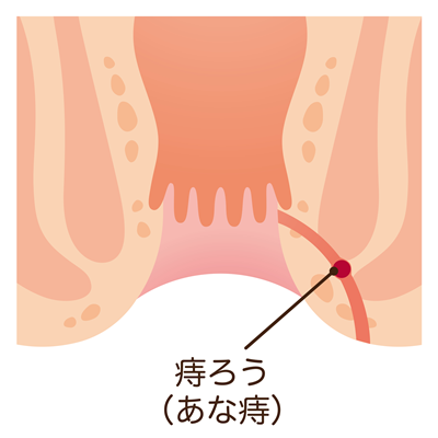 あな痔(痔ろう)