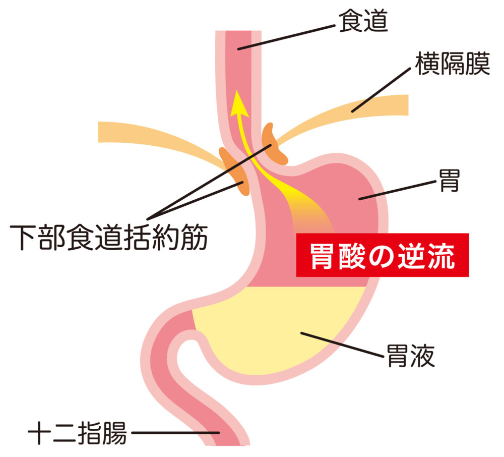 ピロリ菌は除菌しないほうがいいのか